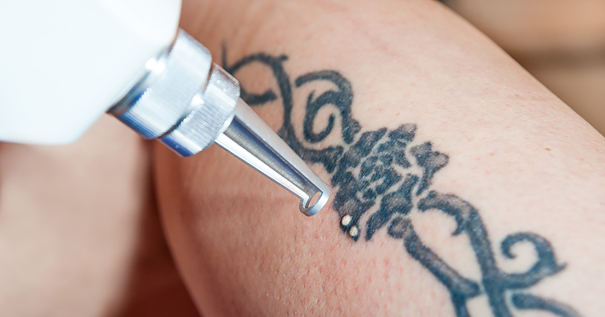 laser tattoo removal process